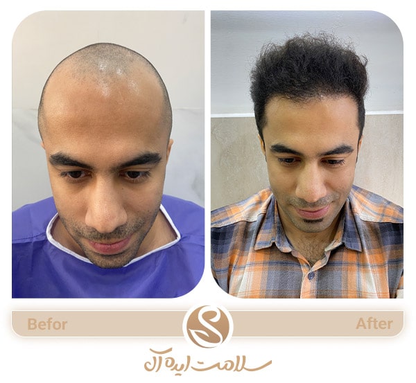 عکس قبل و بعد از کاشت مو